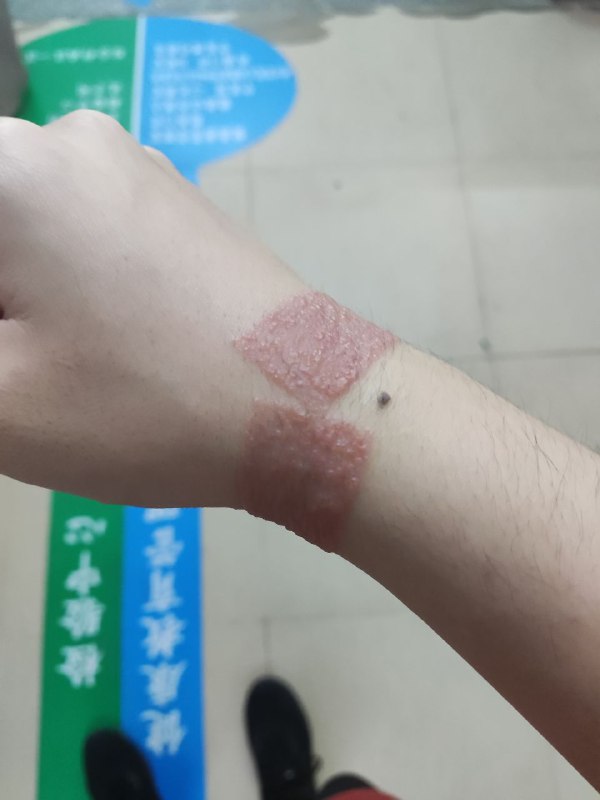 #日常 确认为胶布过敏（慎点）